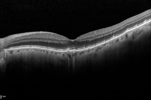 Reticular Macular Disease (Dry Macular Degeneration) -  Spectral Domain Optical Coherence Tomography Line Scan
85 year old woman with 20/25 vision OU and reticular macular disease
