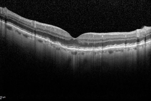 Reticular Macular Disease (Dry Macular Degeneration) - Spectral Domain Optical Coherence Tomography Line Scan
85 year old woman with 20/25 vision OU and reticular macular disease
