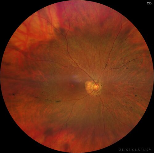 Retinitis Pigmentosa - Autosomal Dominant - Rho Mutation
55 year old female 55 year old female Vision loss since age 25. It runs in the family big time.Â  Paternal grandmother and one of her sisters, father had it, all three of his children had it and her biological nephew have RP.  VA 20/80 OD, 20/125 OS
