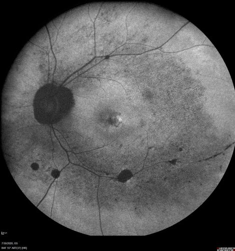 Retinitis Pigmentosa - Autosomal Dominant - Rho Mutation
55 year old female 55 year old female Vision loss since age 25. It runs in the family big time.Â  Paternal grandmother and one of her sisters, father had it, all three of his children had it and her biological nephew have RP.  VA 20/80 OD, 20/125 OS
