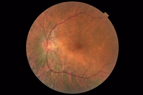 Retinitis Pigmentosa with Cystoid Macular Edema responsive to topical carbonic anhydrase inhibitors
67 year old female  She thought it was time to have her glasses changed.She has no family history of reitnal disease and has never been diagnosed with a problem.   She started having night vision trouble the last year.  Two sisters and a brother with normal vision.  
VA OD: Dcc20/40-2 NccJ3
VA OS: Dcc20/20 NccJ1
IOP: TP: OD:9
