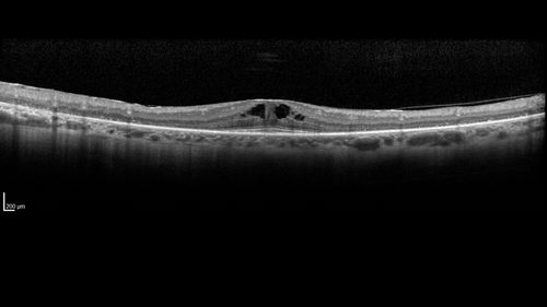 Retinitis Pigmentosa with Cystoid Macular Edema responsive to topical carbonic anhydrase inhibitors
67 year old female  She thought it was time to have her glasses changed.She has no family history of reitnal disease and has never been diagnosed with a problem.   She started having night vision trouble the last year.  Two sisters and a brother with normal vision.  
VA OD: Dcc20/40-2 NccJ3
VA OS: Dcc20/20 NccJ1
IOP: TP: OD:9
