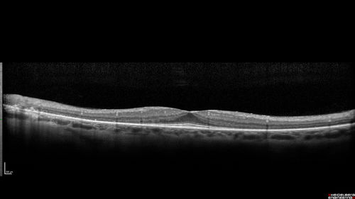 Retinitis Pigmentosa with Cystoid Macular Edema responsive to topical carbonic anhydrase inhibitors
67 year old female  She thought it was time to have her glasses changed.She has no family history of reitnal disease and has never been diagnosed with a problem.   She started having night vision trouble the last year.  Two sisters and a brother with normal vision.  
VA OD: Dcc20/40-2 NccJ3
VA OS: Dcc20/20 NccJ1
IOP: TP: OD:9

