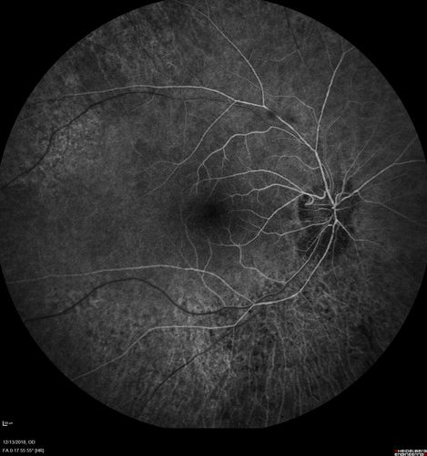 Retinitis Pigmentosa with Cystoid Macular Edema responsive to topical carbonic anhydrase inhibitors
67 year old female  She thought it was time to have her glasses changed.She has no family history of reitnal disease and has never been diagnosed with a problem.   She started having night vision trouble the last year.  Two sisters and a brother with normal vision.  
VA OD: Dcc20/40-2 NccJ3
VA OS: Dcc20/20 NccJ1
IOP: TP: OD:9
