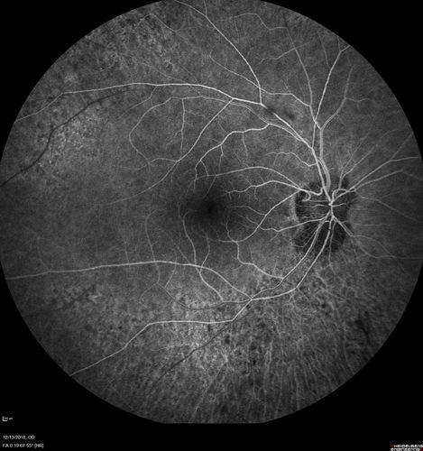 Retinitis Pigmentosa with Cystoid Macular Edema responsive to topical carbonic anhydrase inhibitors
67 year old female  She thought it was time to have her glasses changed.She has no family history of reitnal disease and has never been diagnosed with a problem.   She started having night vision trouble the last year.  Two sisters and a brother with normal vision.  
VA OD: Dcc20/40-2 NccJ3
VA OS: Dcc20/20 NccJ1
IOP: TP: OD:9
