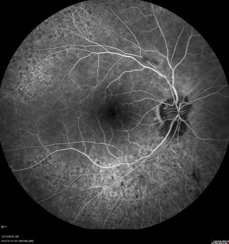 Retinitis Pigmentosa with Cystoid Macular Edema responsive to topical carbonic anhydrase inhibitors
67 year old female  She thought it was time to have her glasses changed.She has no family history of reitnal disease and has never been diagnosed with a problem.   She started having night vision trouble the last year.  Two sisters and a brother with normal vision.  
VA OD: Dcc20/40-2 NccJ3
VA OS: Dcc20/20 NccJ1
IOP: TP: OD:9
