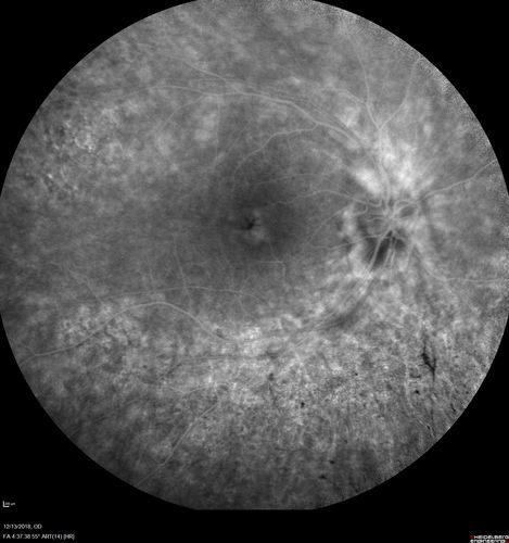 Retinitis Pigmentosa with Cystoid Macular Edema responsive to topical carbonic anhydrase inhibitors
67 year old female  She thought it was time to have her glasses changed.She has no family history of reitnal disease and has never been diagnosed with a problem.   She started having night vision trouble the last year.  Two sisters and a brother with normal vision.  
VA OD: Dcc20/40-2 NccJ3
VA OS: Dcc20/20 NccJ1
IOP: TP: OD:9
