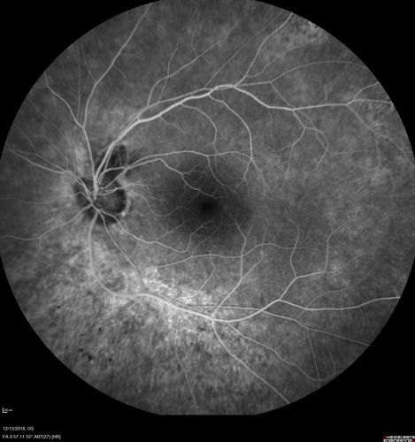 Retinitis Pigmentosa with Cystoid Macular Edema responsive to topical carbonic anhydrase inhibitors
67 year old female  She thought it was time to have her glasses changed.She has no family history of reitnal disease and has never been diagnosed with a problem.   She started having night vision trouble the last year.  Two sisters and a brother with normal vision.  
VA OD: Dcc20/40-2 NccJ3
VA OS: Dcc20/20 NccJ1
IOP: TP: OD:9
