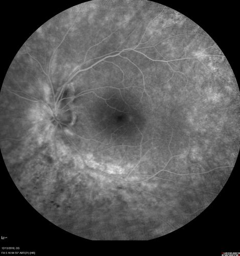 Retinitis Pigmentosa with Cystoid Macular Edema responsive to topical carbonic anhydrase inhibitors
67 year old female  She thought it was time to have her glasses changed.She has no family history of reitnal disease and has never been diagnosed with a problem.   She started having night vision trouble the last year.  Two sisters and a brother with normal vision.  
VA OD: Dcc20/40-2 NccJ3
VA OS: Dcc20/20 NccJ1
IOP: TP: OD:9
