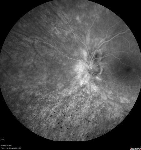 Retinitis Pigmentosa with Cystoid Macular Edema responsive to topical carbonic anhydrase inhibitors
67 year old female  She thought it was time to have her glasses changed.She has no family history of reitnal disease and has never been diagnosed with a problem.   She started having night vision trouble the last year.  Two sisters and a brother with normal vision.  
VA OD: Dcc20/40-2 NccJ3
VA OS: Dcc20/20 NccJ1
IOP: TP: OD:9
