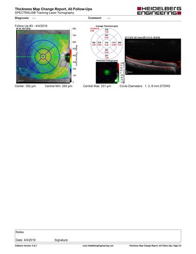 Retinitis Pigmentosa with Cystoid Macular Edema responsive to topical carbonic anhydrase inhibitors
67 year old female  She thought it was time to have her glasses changed.She has no family history of reitnal disease and has never been diagnosed with a problem.   She started having night vision trouble the last year.  Two sisters and a brother with normal vision.  
VA OD: Dcc20/40-2 NccJ3
VA OS: Dcc20/20 NccJ1
IOP: TP: OD:9
