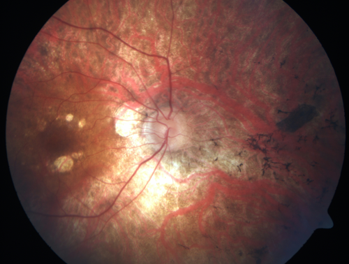 Retinitis Pigmentosa - RP1 Mutation
78 year old man: 20/32 OD and 20/50 OS -  RP1 Gene is Bad -- > RP with Novel Amino Acid Change in GLY723Stop sequence of the RP1 gene - consistent with AD RP
