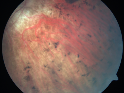 Retinitis Pigmentosa - RP1 Mutation
78 year old man: 20/32 OD and 20/50 OS -  RP1 Gene is Bad -- > RP with Novel Amino Acid Change in GLY723Stop sequence of the RP1 gene - consistent with AD RP
