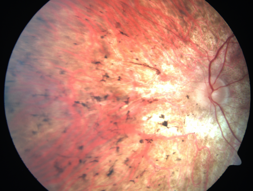 Retinitis Pigmentosa - RP1 Mutation
78 year old man: 20/32 OD and 20/50 OS -  RP1 Gene is Bad -- > RP with Novel Amino Acid Change in GLY723Stop sequence of the RP1 gene - consistent with AD RP
