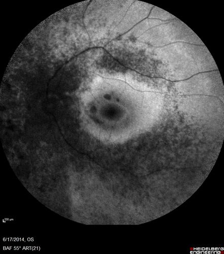 Retinitis Pigmentosa - RP1 Mutation
78 year old man: 20/32 OD and 20/50 OS -  RP1 Gene is Bad -- > RP with Novel Amino Acid Change in GLY723Stop sequence of the RP1 gene - consistent with AD RP
