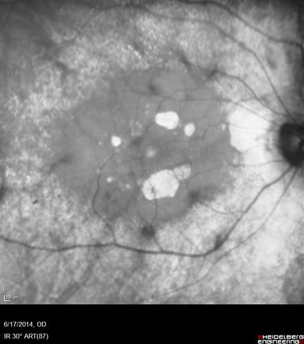 Retinitis Pigmentosa - RP1 Mutation
78 year old man: 20/32 OD and 20/50 OS -  RP1 Gene is Bad -- > RP with Novel Amino Acid Change in GLY723Stop sequence of the RP1 gene - consistent with AD RP
