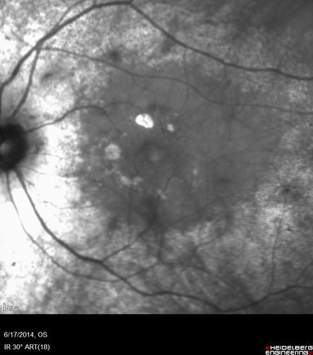 Retinitis Pigmentosa - RP1 Mutation
78 year old man: 20/32 OD and 20/50 OS -  RP1 Gene is Bad -- > RP with Novel Amino Acid Change in GLY723Stop sequence of the RP1 gene - consistent with AD RP
