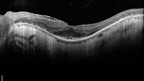 Retinitis Pigmentosa - RP1 Mutation
78 year old man: 20/32 OD and 20/50 OS -  RP1 Gene is Bad -- > RP with Novel Amino Acid Change in GLY723Stop sequence of the RP1 gene - consistent with AD RP
