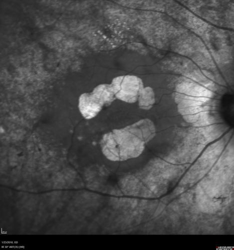 Retinitis Pigmentosa - RP1 Mutation
78 year old man: 20/32 OD and 20/50 OS -  RP1 Gene is Bad -- > RP with Novel Amino Acid Change in GLY723Stop sequence of the RP1 gene - consistent with AD RP
