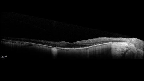 Retinitis Pigmentosa - RP1 Mutation
78 year old man: 20/32 OD and 20/50 OS -  RP1 Gene is Bad -- > RP with Novel Amino Acid Change in GLY723Stop sequence of the RP1 gene - consistent with AD RP
