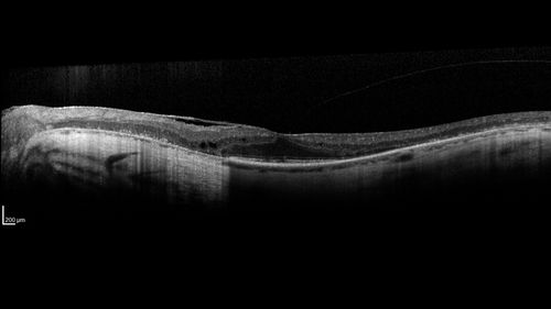 Retinitis Pigmentosa - RP1 Mutation
78 year old man: 20/32 OD and 20/50 OS -  RP1 Gene is Bad -- > RP with Novel Amino Acid Change in GLY723Stop sequence of the RP1 gene - consistent with AD RP
