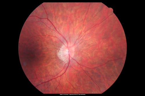 Retinitis Pigmentosa Sine Pigmento 
