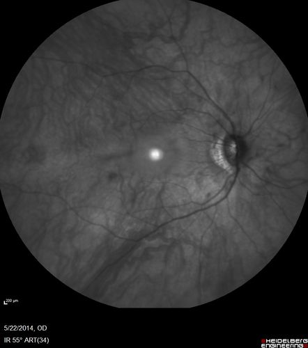 Retinitis Pigmentosa Sine Pigmento 

