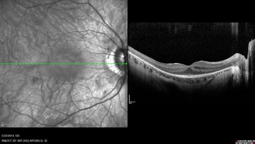 Retinitis Pigmentosa Sine Pigmento 
