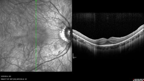 Retinitis Pigmentosa Sine Pigmento 
