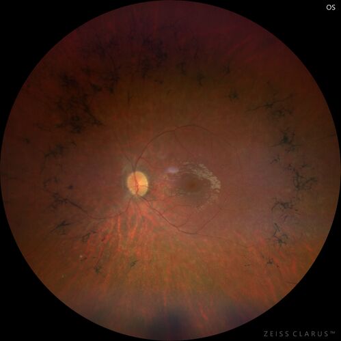 Usher Syndrome - USH2A
23 year old female Extended HPI: Vision trouble for about five years. She has some trouble with night vision and was told that her retina looked abnormal.  There are no family members that are known to have an inherited retinal disease. 
Medical Hx: Sensorial Neural Hearing Loss. Chorionic migranes. 
Systemic Meds: None.
VA 20/32 OD, 20/25 OS
Color vision normal

Heterozygous for USH2A pathological mutation and for an USH2A VUS
