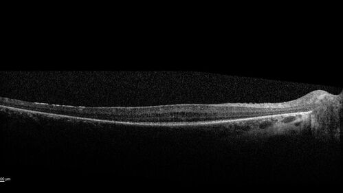 Usher Syndrome - USH2A
23 year old female Extended HPI: Vision trouble for about five years. She has some trouble with night vision and was told that her retina looked abnormal.  There are no family members that are known to have an inherited retinal disease. 
Medical Hx: Sensorial Neural Hearing Loss. Chorionic migranes. 
Systemic Meds: None.
VA 20/32 OD, 20/25 OS
Color vision normal

Heterozygous for USH2A pathological mutation and for an USH2A VUS
