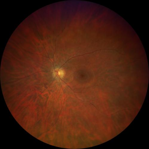 Retinitis Pigmentosa - Autosomal Recessive - 20/25 Vision
49 year old man 15 years ago he noticed decreased night vision.  
VA OD: sc20/25 NscJ2
VA OS: sc20/25-2 NscJ2-1
IOP: TP: OD:17 OS:19 

Genetic testing showed heterozygous for RPE65 - Probably not clinically important
