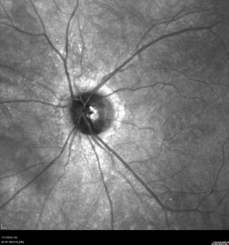Retinitis Pigmentosa - Autosomal Recessive - 20/25 Vision
49 year old man 15 years ago he noticed decreased night vision.  
VA OD: sc20/25 NscJ2
VA OS: sc20/25-2 NscJ2-1
IOP: TP: OD:17 OS:19 

Genetic testing showed heterozygous for RPE65 - Probably not clinically important
