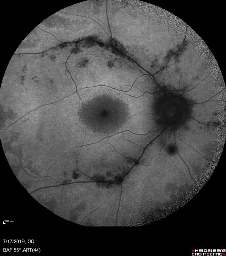 Retinitis Pigmentosa - Autosomal Recessive - 20/25 Vision
49 year old man 15 years ago he noticed decreased night vision.  
VA OD: sc20/25 NscJ2
VA OS: sc20/25-2 NscJ2-1
IOP: TP: OD:17 OS:19 

Genetic testing showed heterozygous for RPE65 - Probably not clinically important
