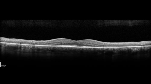 Retinitis Pigmentosa - Autosomal Recessive - 20/25 Vision
49 year old man 15 years ago he noticed decreased night vision.  
VA OD: sc20/25 NscJ2
VA OS: sc20/25-2 NscJ2-1
IOP: TP: OD:17 OS:19 

Genetic testing showed heterozygous for RPE65 - Probably not clinically important
