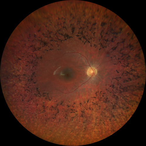 Retinitis Pigmentosa - Simplex - 16 year old female good vision
Difficulty with night vision
No family history
VA 20/25 OD, 20/16 OS
Negative for RPE65
