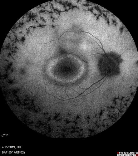 Retinitis Pigmentosa - Simplex - 16 year old female good vision
Difficulty with night vision
No family history
VA 20/25 OD, 20/16 OS
Negative for RPE65
