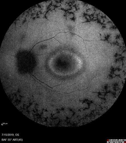 Retinitis Pigmentosa - Simplex - 16 year old female good vision
Difficulty with night vision
No family history
VA 20/25 OD, 20/16 OS
Negative for RPE65
