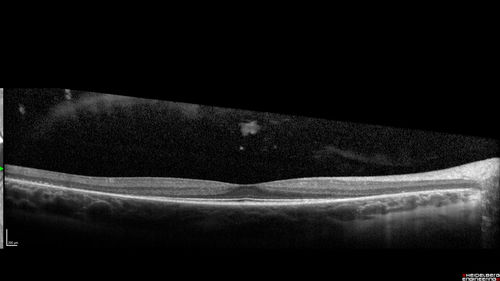 Retinitis Pigmentosa - Simplex - 16 year old female good vision
Difficulty with night vision
No family history
VA 20/25 OD, 20/16 OS
Negative for RPE65
