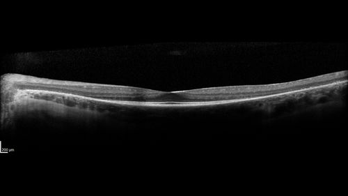 Retinitis Pigmentosa - Simplex - 16 year old female good vision
Difficulty with night vision
No family history
VA 20/25 OD, 20/16 OS
Negative for RPE65
