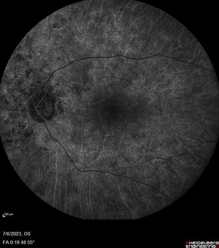 Radiation Retinopathy Both Eyes - 2023 - Two years after radiation for ocular lymphoma  (10)
