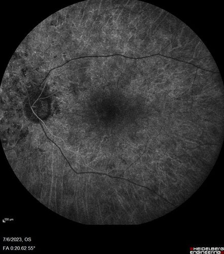 Radiation Retinopathy Both Eyes - 2023 - Two years after radiation for ocular lymphoma  (11)
