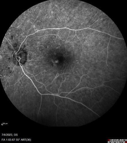 Radiation Retinopathy Both Eyes - 2023 - Two years after radiation for ocular lymphoma  (19)
