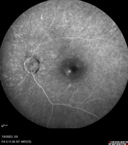 Radiation Retinopathy Both Eyes - 2023 - Two years after radiation for ocular lymphoma  (21)
