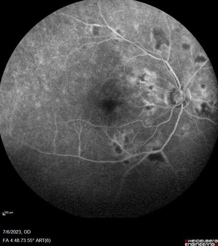 Radiation Retinopathy Both Eyes - 2023 - Two years after radiation for ocular lymphoma  (24)
