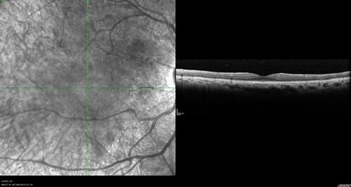 Radiation Retinopathy Both Eyes - 2023 - Two years after radiation for ocular lymphoma  (4)
