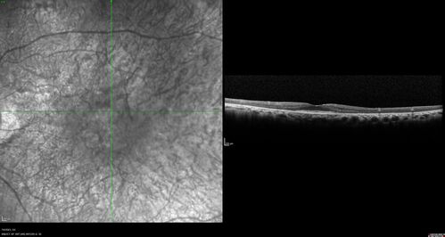 Radiation Retinopathy Both Eyes - 2023 - Two years after radiation for ocular lymphoma  (6)
