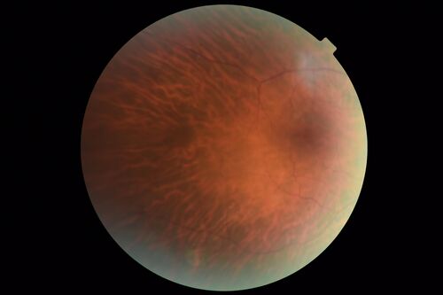 Retinitis Pigmentosa - X-linked Recessive
60 year old man The vision in the right eye is blurry recently.  He has trouble with night vision for about 3 years.  His brother has eye disease in Michigan.  
VA OD: Dcc20/32-1 PHNI NccJ1-1
VA OS: Dcc20/20 NccJ1+-1
IOP: TP: OD:36 OS:18 
He has pseudoexfoliative glaucoma in the right eye.
