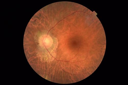 Retinitis Pigmentosa - X-linked Recessive
60 year old man The vision in the right eye is blurry recently.  He has trouble with night vision for about 3 years.  His brother has eye disease in Michigan.  
VA OD: Dcc20/32-1 PHNI NccJ1-1
VA OS: Dcc20/20 NccJ1+-1
IOP: TP: OD:36 OS:18 
He has pseudoexfoliative glaucoma in the right eye.
