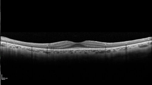 Retinitis Pigmentosa - X-linked Recessive
60 year old man The vision in the right eye is blurry recently.  He has trouble with night vision for about 3 years.  His brother has eye disease in Michigan.  
VA OD: Dcc20/32-1 PHNI NccJ1-1
VA OS: Dcc20/20 NccJ1+-1
IOP: TP: OD:36 OS:18 
He has pseudoexfoliative glaucoma in the right eye.
